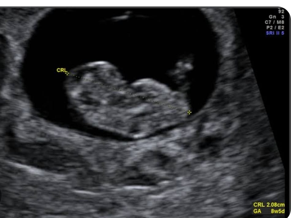 Abdomino Pelvic USG