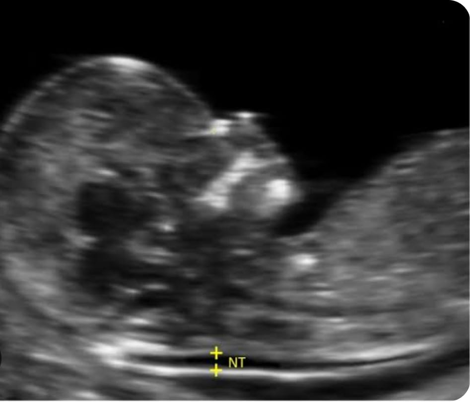NT / FTS Scan