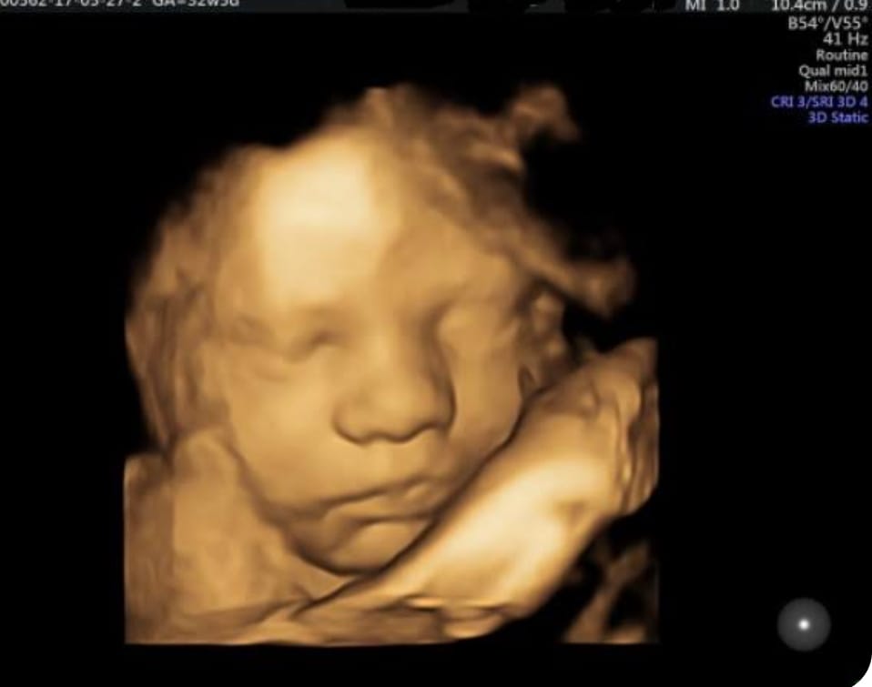 Advance 3D and 4D Sonography