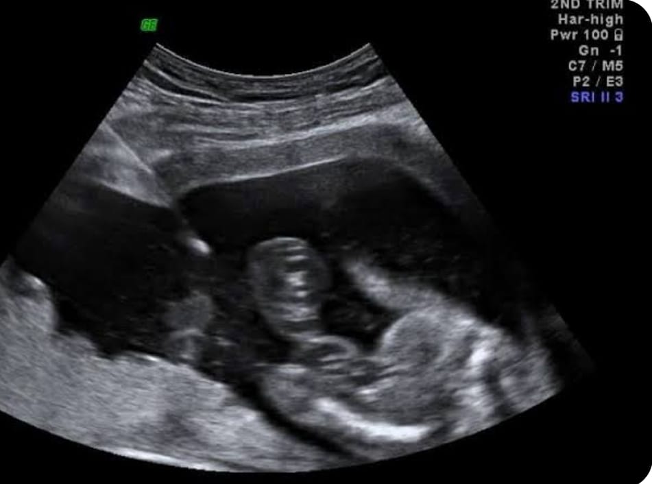 Amniocentesis