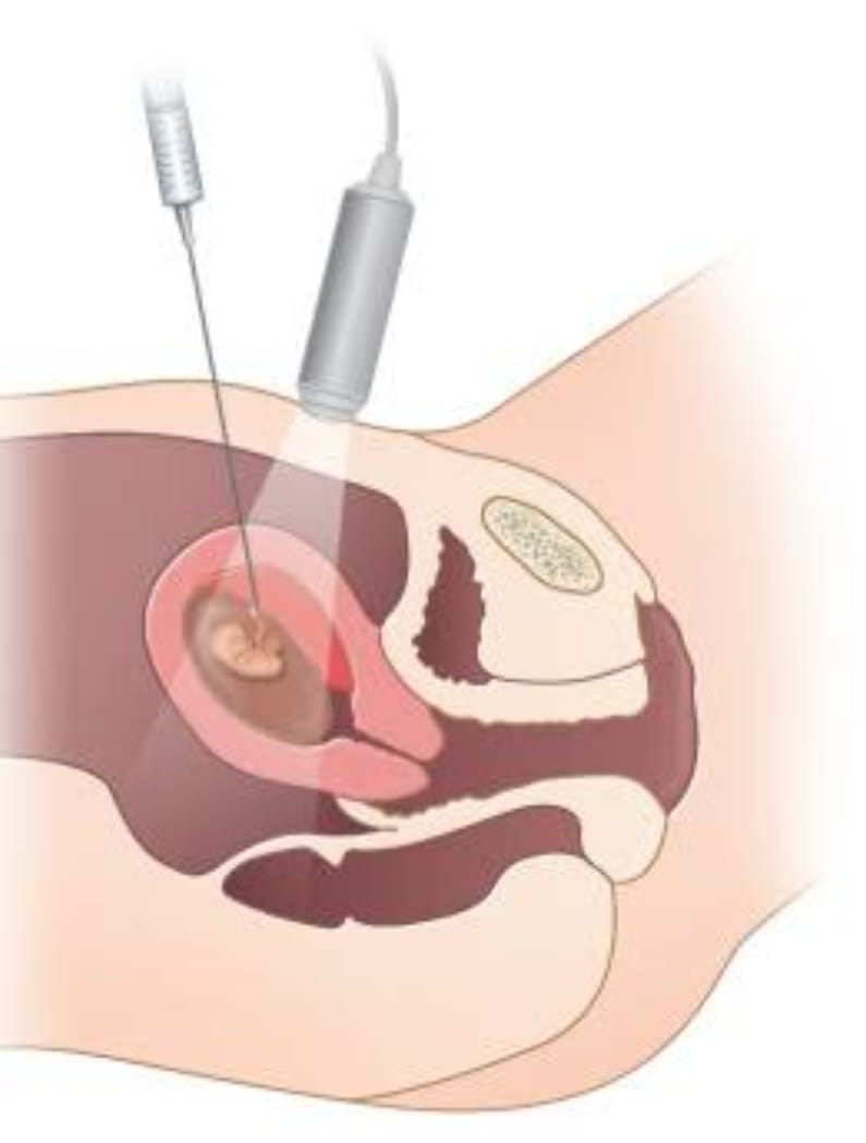 Chorionic Villous Sampling