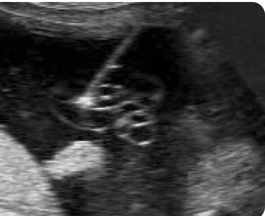 Cord Blood Sampling