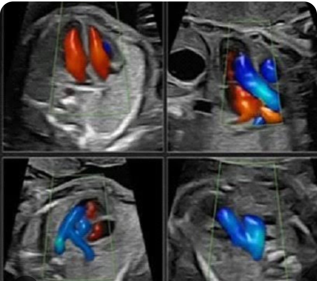 Fetal Echo