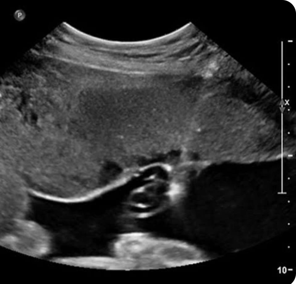 Invasive Fetal Procedure
